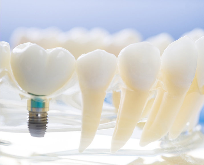 Implants Specialist