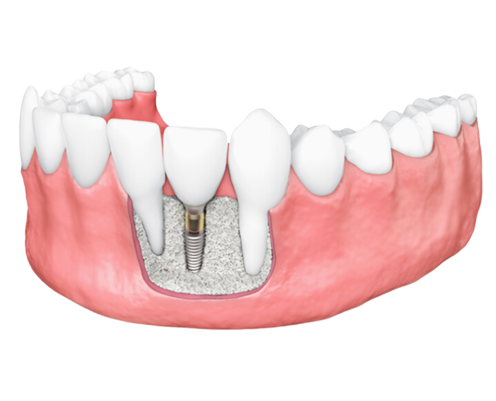 Bone Grafting