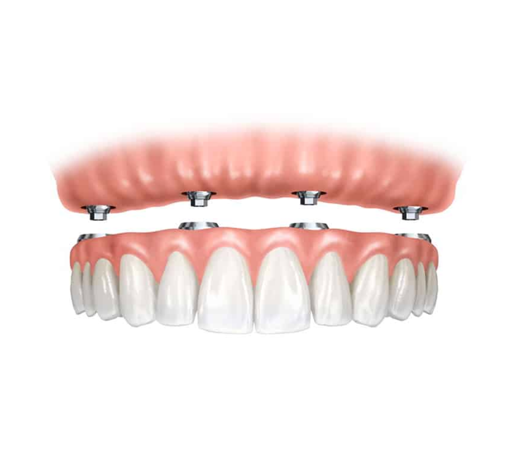 All on 4 dental implants